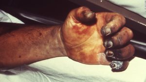The History of Smallpox - 'The Speckled Monster' - from 1600 to 1977 5 Plague