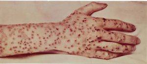 The History of Smallpox - 'The Speckled Monster' - from 1600 to 1977 4 Smallpox