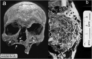 The Archaeology of Disease Documented in Skeletons