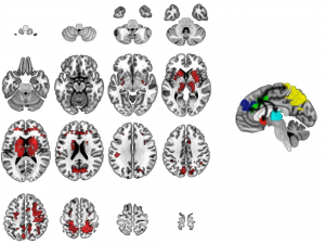 Mental Illness is Readily Visible in Brain Imaging 17 Mental Illness is Readily Visible in Brain Imaging