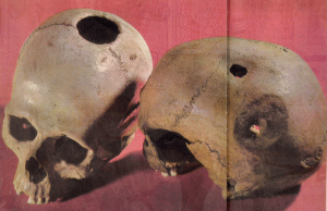 Literally "Like a Hole in the Head": Trephination in the Ancient World 67 071518-60-Trephination-Surgery-Medicine-Ancient-History