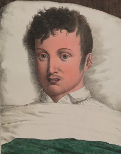 Ungesund: Yellow Fever, the Antebellum Gulf South, and German Immigration