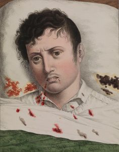 Ungesund: Yellow Fever, the Antebellum Gulf South, and German Immigration