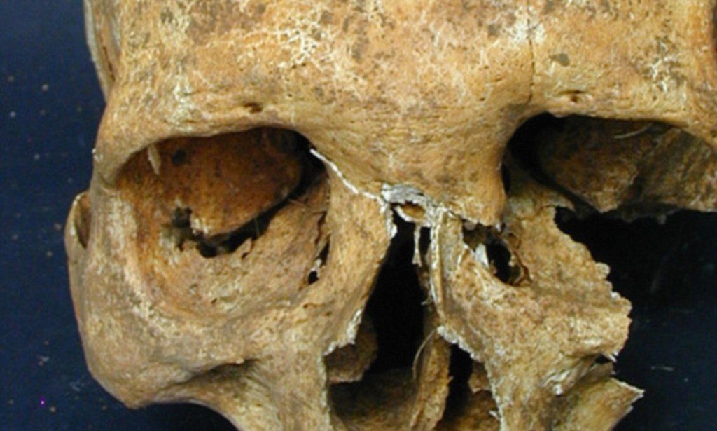 An unhealed gash on the forehead suggests that the man died a violent death