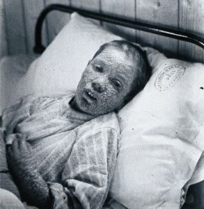 Children as Victims of Anti-Vaxxers in 19th-Century Britain 40 Children as Victims of Anti-Vaxxers in 19th-Century Britain