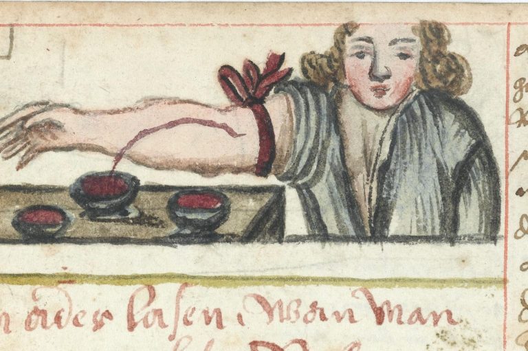 042020-21-History-Ancient-Medieval-Middle-Ages-Medicine-Bloodletting