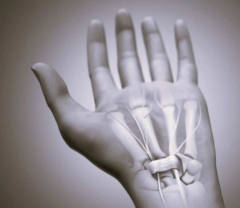 PreventCarpalTunnel-RGEugenio01