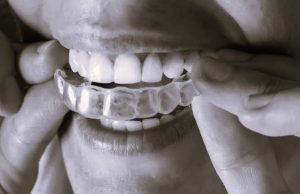 BenefitsInvisalign-HannahGilbert02