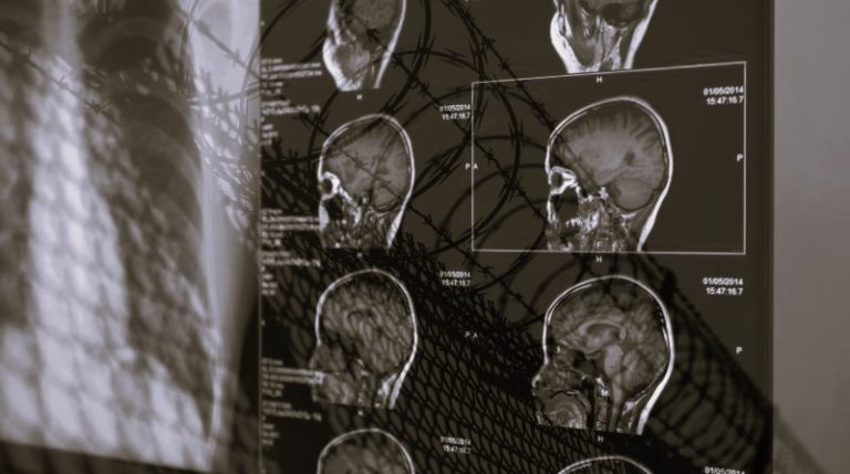 BrainInjury-Angeline01