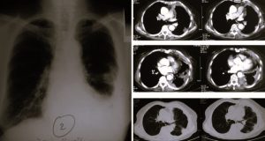 Mesothelioma Compensation: What Family Members Need to Know 26 MesotheliomaAttorney-angeline01