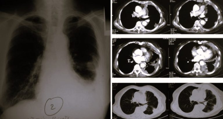 MesotheliomaAttorney-angeline01