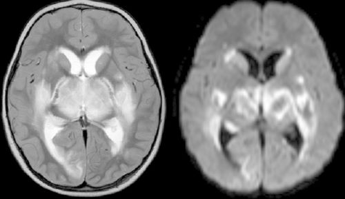 Quiet Catastrophe: Rising Cases of ANE in Children and a New Front in Fighting the Flu 10 Brain scan