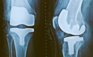 KneeReplacement-SVBCBE88029-HannahGilbert02