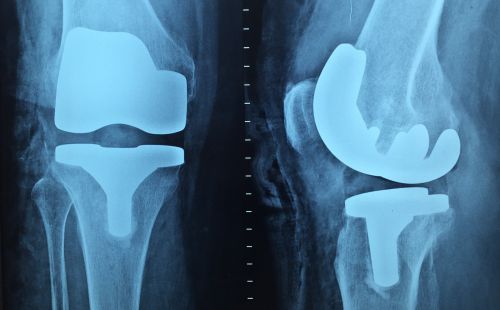 Getting Ready for Knee Replacement in the Mesquite Area 2 Getting Ready for Knee Replacement in the Mesquite Area