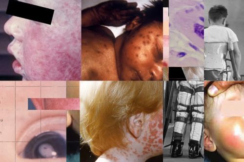 Long-Dormant and Decreasing Diseases Find a Friend in RFK, Jr. to Rise Again