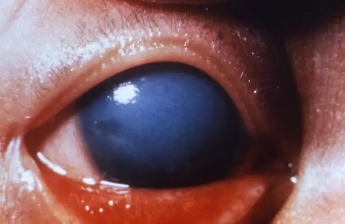 Long-Dormant and Decreasing Diseases Find a Friend in RFK, Jr. to Rise Again