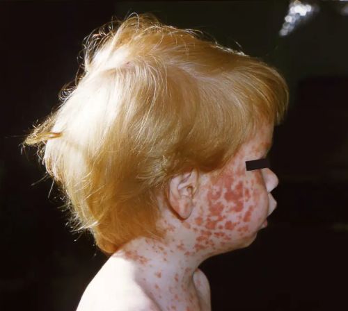 Long-Dormant and Decreasing Diseases Find a Friend in RFK, Jr. to Rise Again