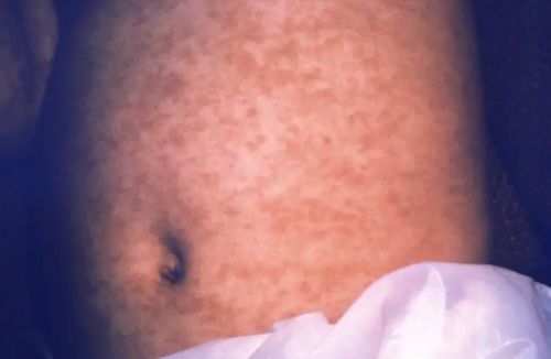 Long-Dormant and Decreasing Diseases Find a Friend in RFK, Jr. to Rise Again