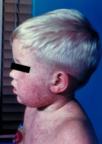 Long-Dormant and Decreasing Diseases Find a Friend in RFK, Jr. to Rise Again