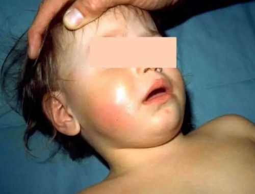 Long-Dormant and Decreasing Diseases Find a Friend in RFK, Jr. to Rise Again