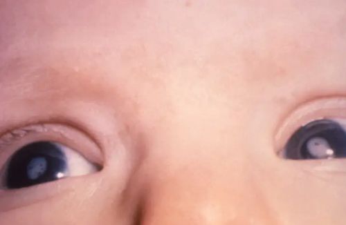 Long-Dormant and Decreasing Diseases Find a Friend in RFK, Jr. to Rise Again