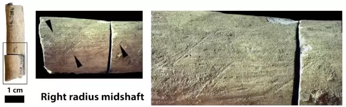 Marks incised on the shaft of the lower arm bone (radius) were inflicted by a stone tool
