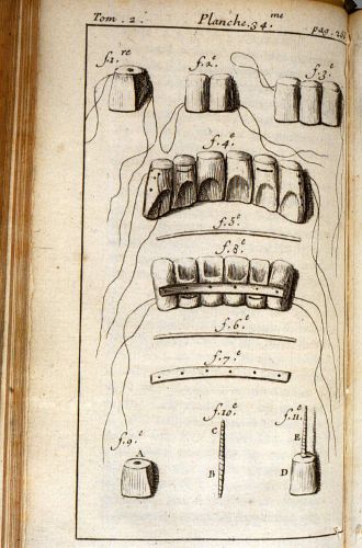 Early 18th century diagram made by doctor Fauchard on his book where he shows the procedure involved in denture construction