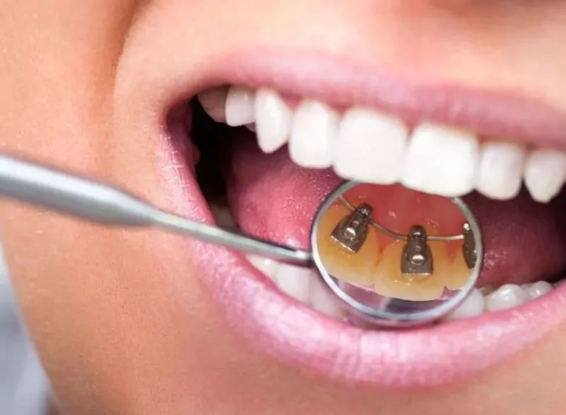 Navigating Overbite Braces Treatment Options for a Healthier Smile