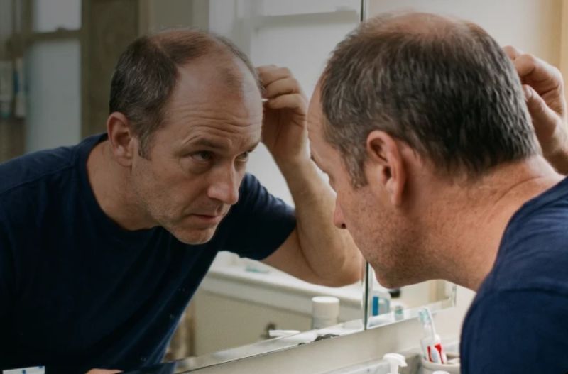 Is Hair Loss Really a Sign of Low Testosterone? Sorting Fact Out